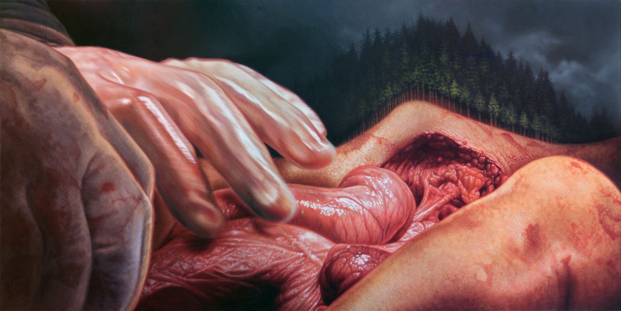 Close-up painting of gloved hands manipulating exposed pink organs, with a dark evergreen forest and stormy sky rising behind the incision.