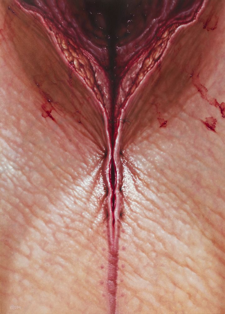My contribution to the exhibition, Heals All Wounds, 50 x 70 cm, oil on panel, 2014. Showing the evolution of a wound over time, with various features of the composition combining to form the shape of an hourglass.